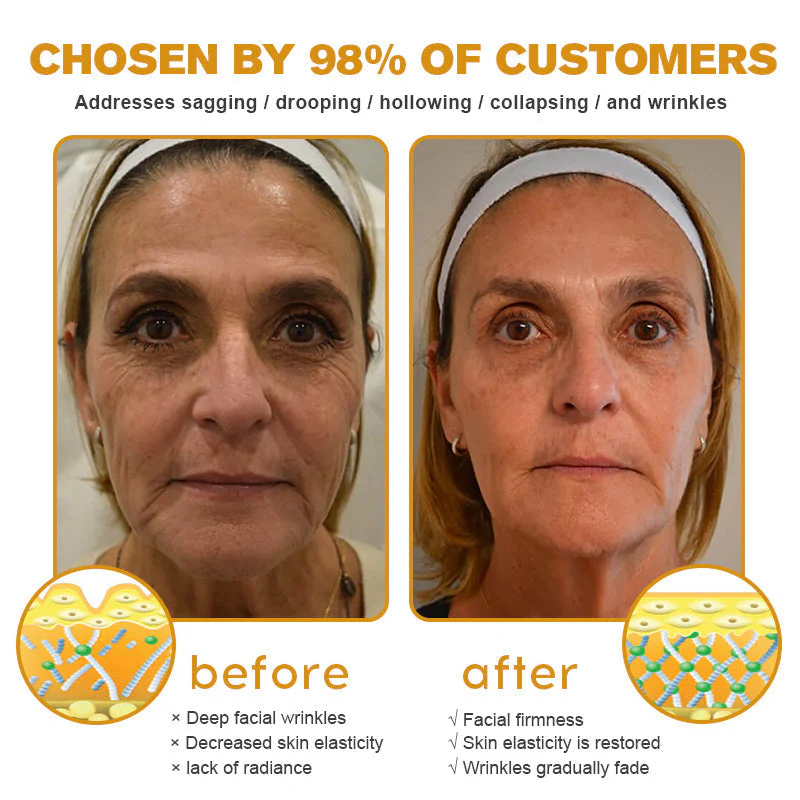 👨‍⚕️ Made and Shipped from US✅ Botox Bee Venom Wrinkle Removal Cream- LAST DAY 80% OFF
