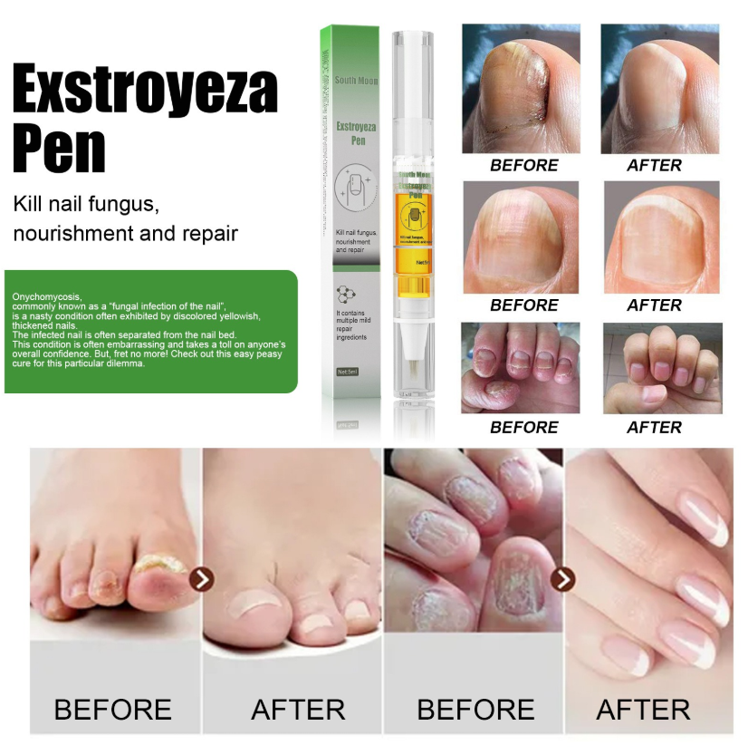 Anti-Fungal Pen – Gets Rid Of Even the Most Stubborn Nail Fungus