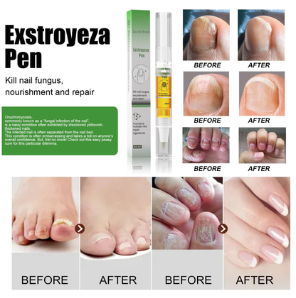 Anti-Fungal Pen – Gets Rid Of Even the Most Stubborn Nail Fungus