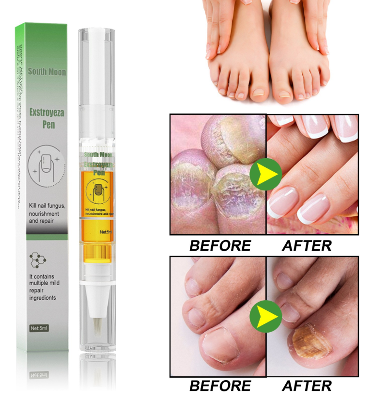 Anti-Fungal Pen – Gets Rid Of Even the Most Stubborn Nail Fungus