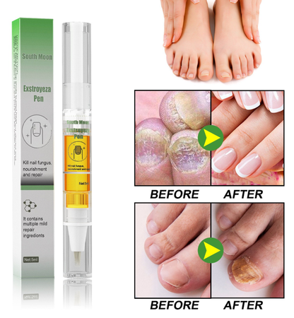 Anti-Fungal Pen – Gets Rid Of Even the Most Stubborn Nail Fungus